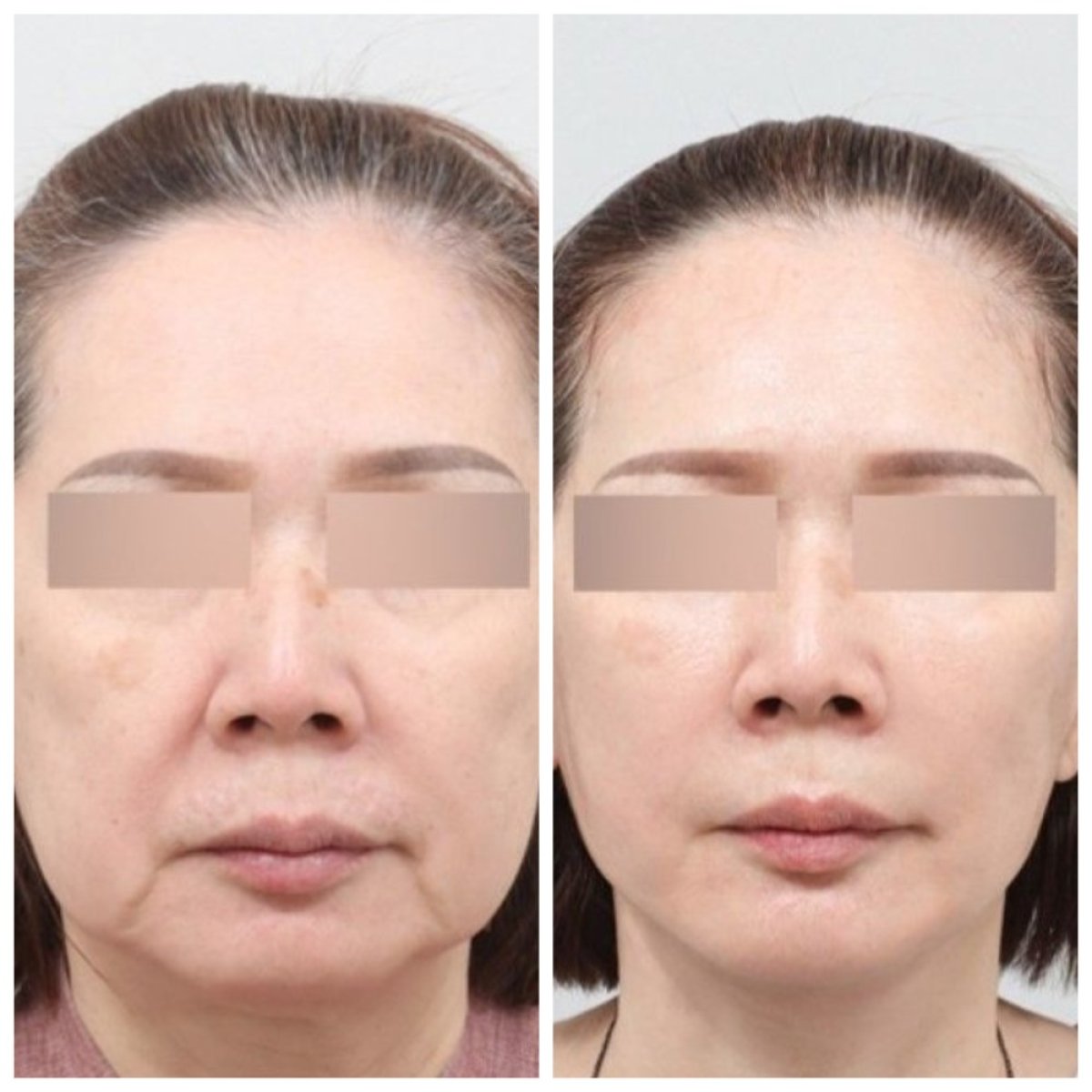 Before and after blepharoplasty results at AB Plastic Surgery, eyelid correction improvement
