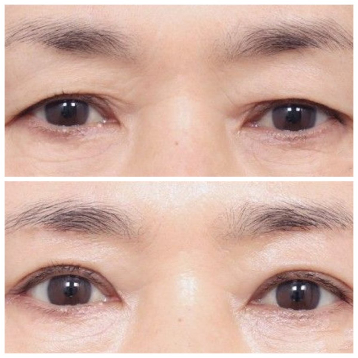 Before and after upper and lower eyelid surgery results at AB Plastic Surgery, rejuvenated eyes