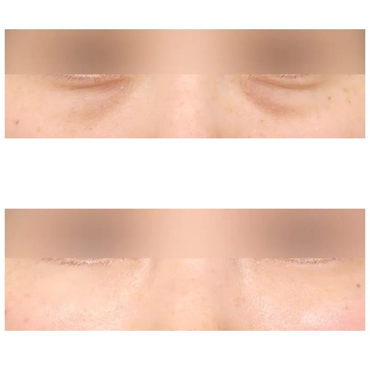 Resultados de blefaroplastia de párpado inferior antes y después en AB Plastic Surgery