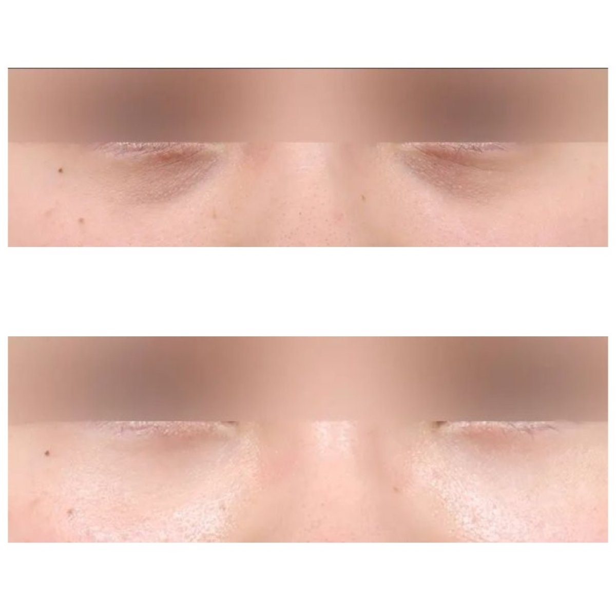 Resultados de blefaroplastia de párpado inferior antes y después en AB Plastic Surgery