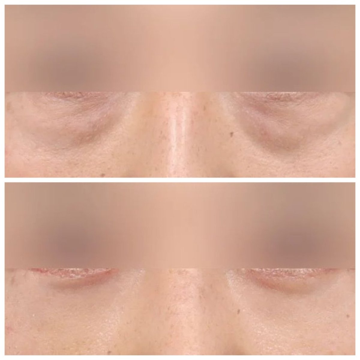 Результаты блефаропластики нижних век до и после в AB Plastic Surgery, уменьшены мешки