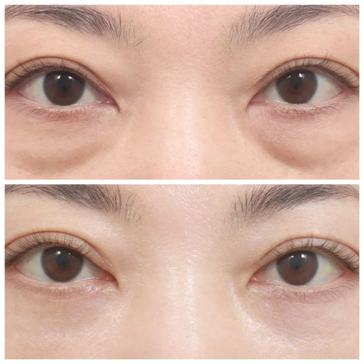 Résultats avant/après blépharoplastie des paupières inférieures chez AB Plastic Surgery