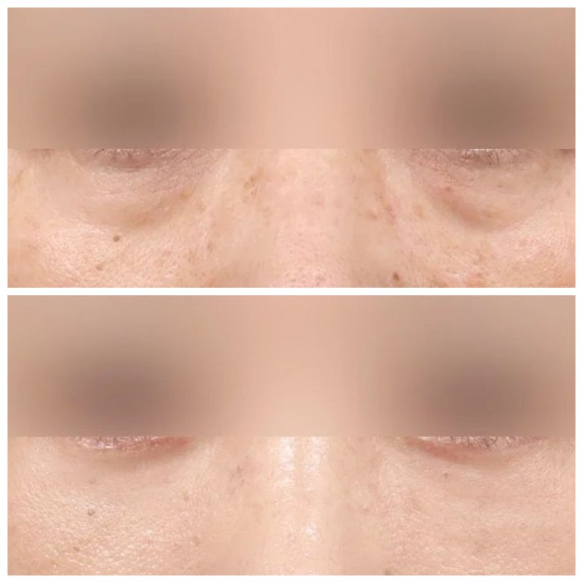 Resultados de blefaroplastia inferior antes y después en AB Plastic Surgery, menos bolsas