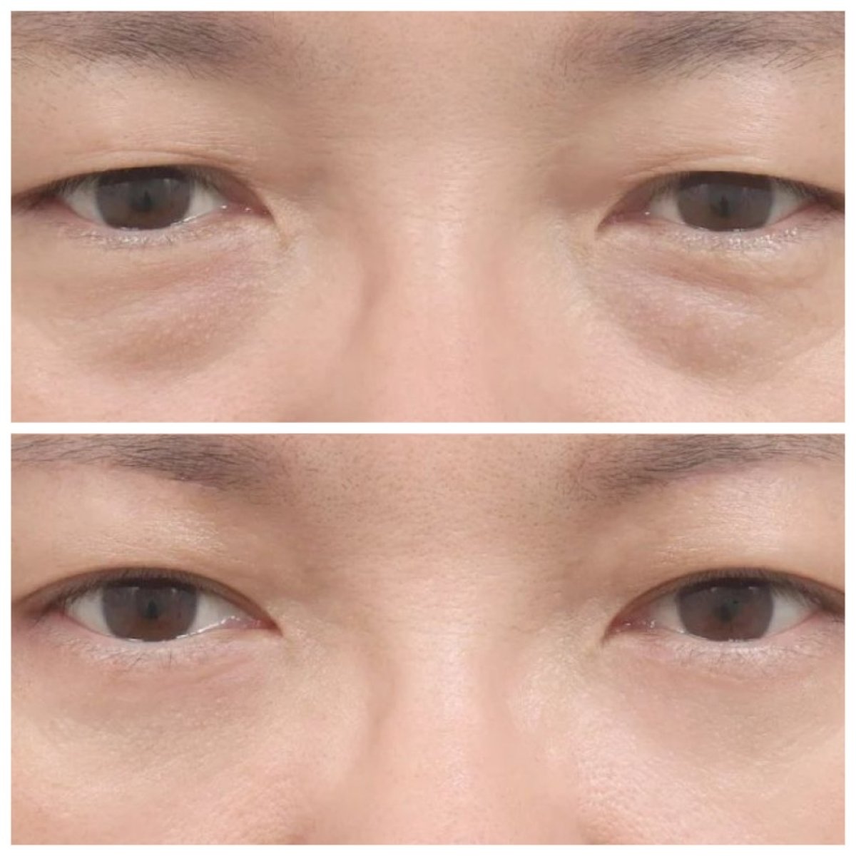 Résultats avant/après blépharoplastie inférieure chez AB Plastic Surgery, poches réduites