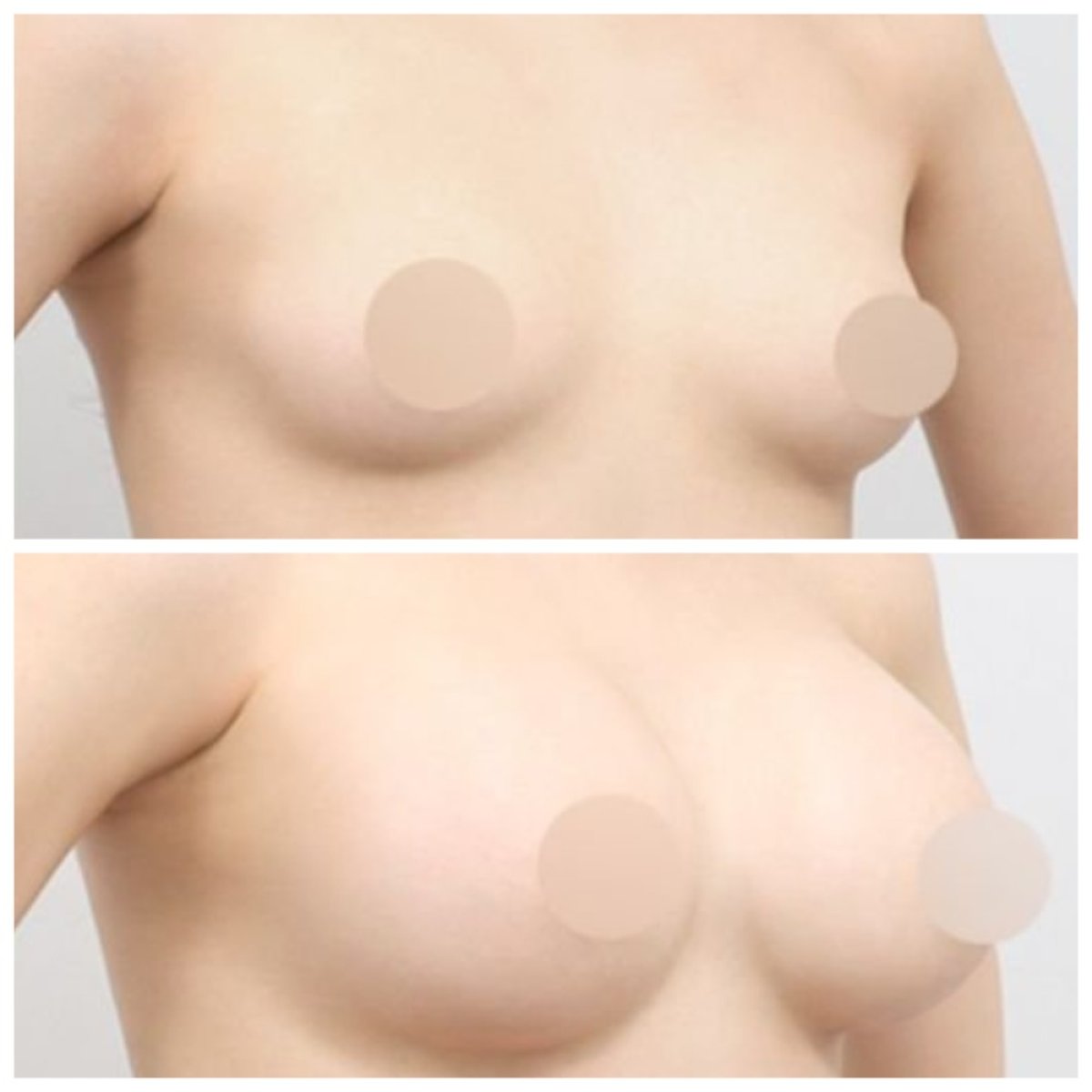 Результати до і після збільшення грудей в AB Plastic Surgery – збільшений об’єм грудей