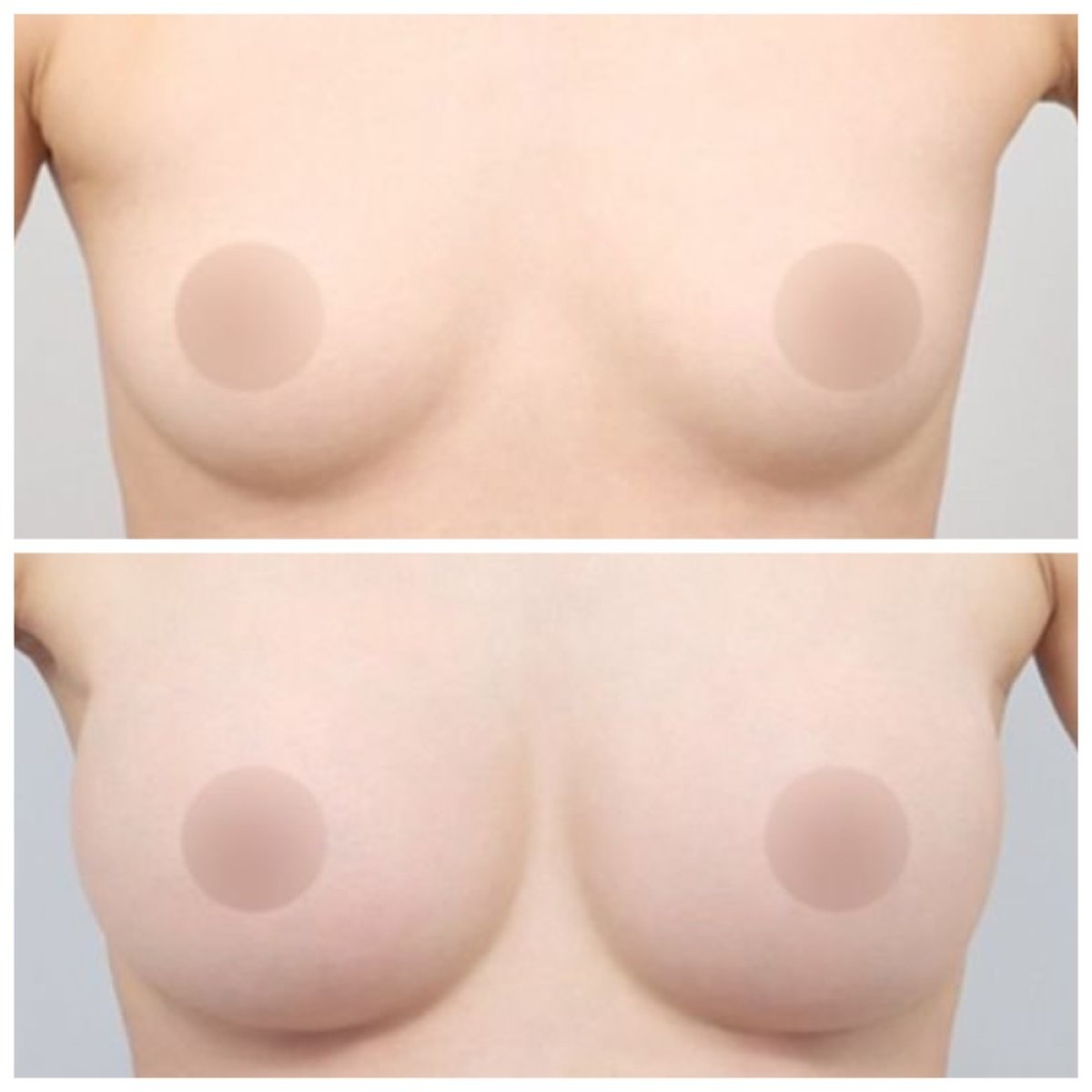 Результаты до и после увеличения груди в AB Plastic Surgery – увеличенный объем груди