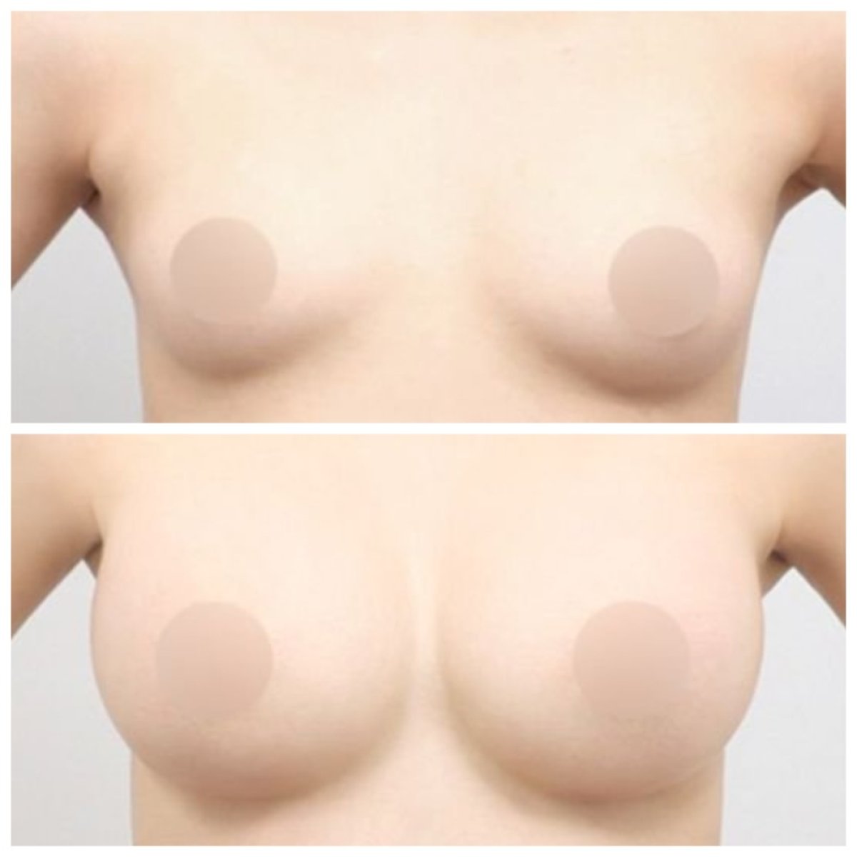 Resultados antes y después de aumento de senos en AB Plastic Surgery, mayor volumen mamario