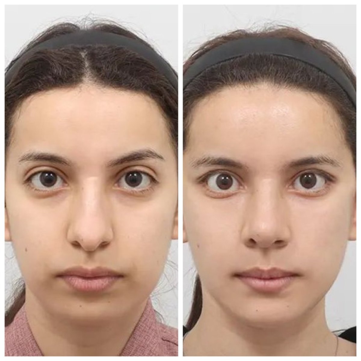 نتائج قبل وبعد Fox Eye Lift في AB Plastic Surgery، تحسين واضح لمحيط العين