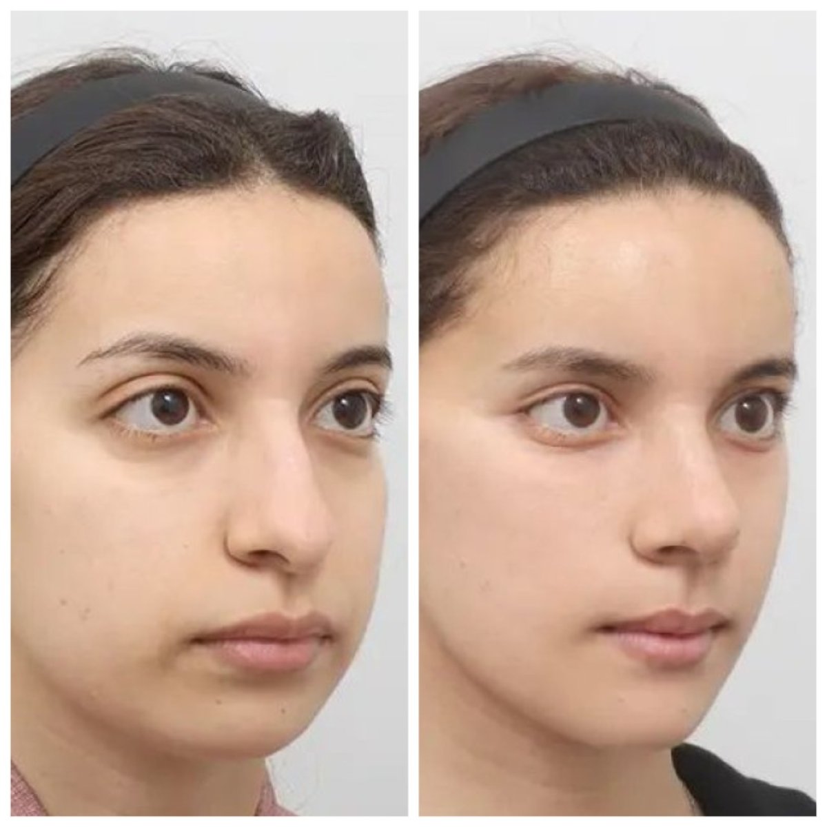 Результати до та після Fox Eye Lift в AB Plastic Surgery, помітне покращення контуру очей