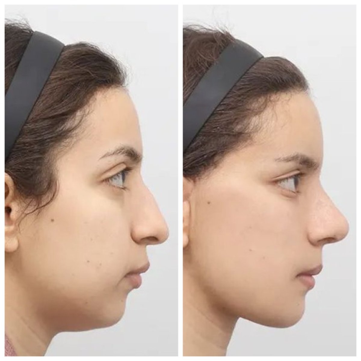 Результати до і після Fox Eye Lift у AB Plastic Surgery, помітний ліфтинг очей