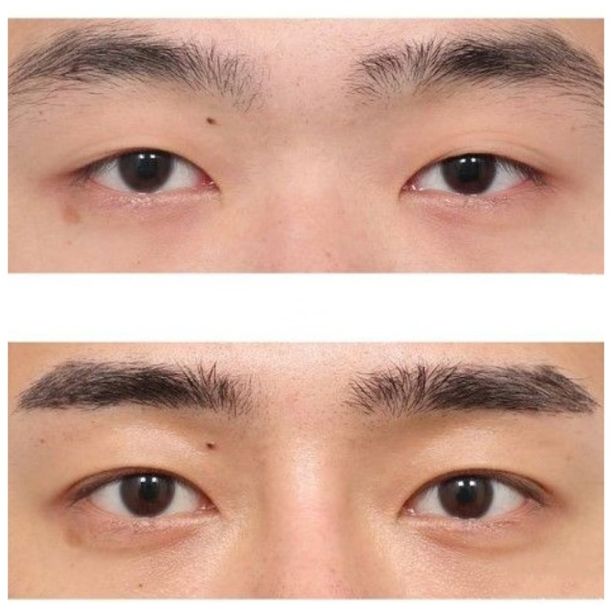 Before and after blepharoplasty results at AB Plastic Surgery, eyelid correction improvement