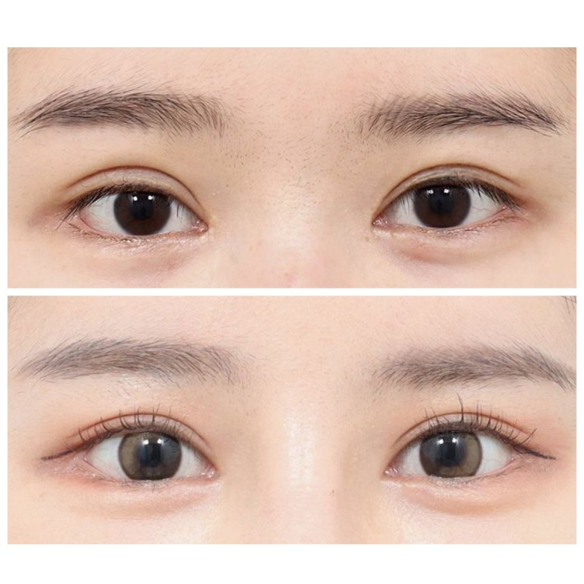 Résultats avant/après blépharoplastie supérieure chez AB Plastic Surgery, regard éclairci
