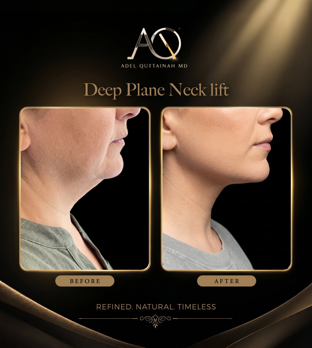 Результати до і після deep plane neck lift у Adel Quttainah MD – чіткіший контур підборіддя