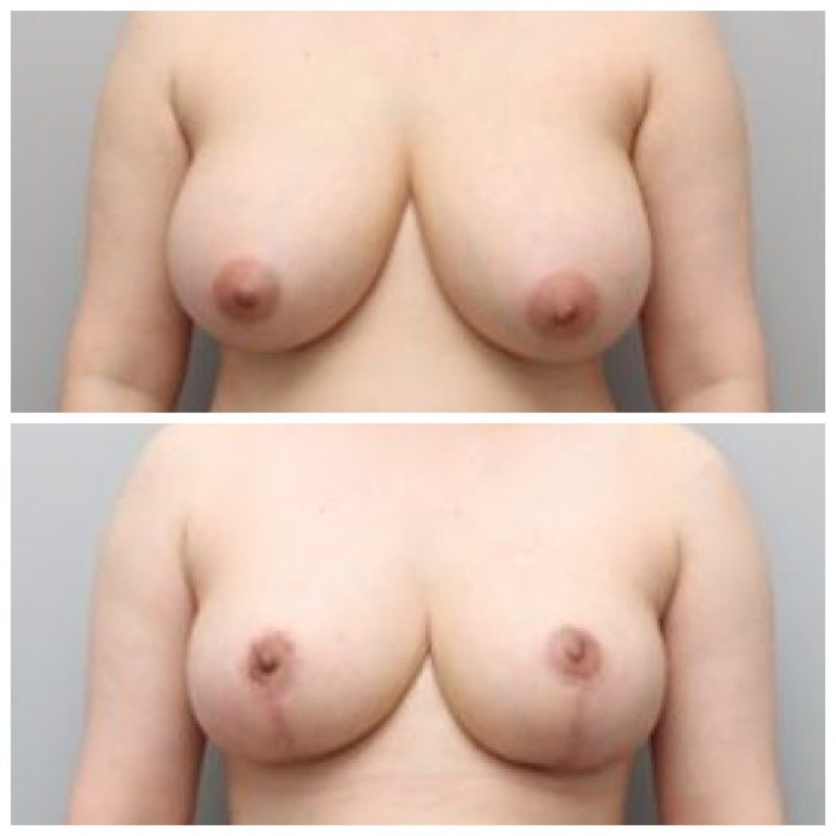 Before and after breast lift results at AB Plastic Surgery – improved breast shape and lift