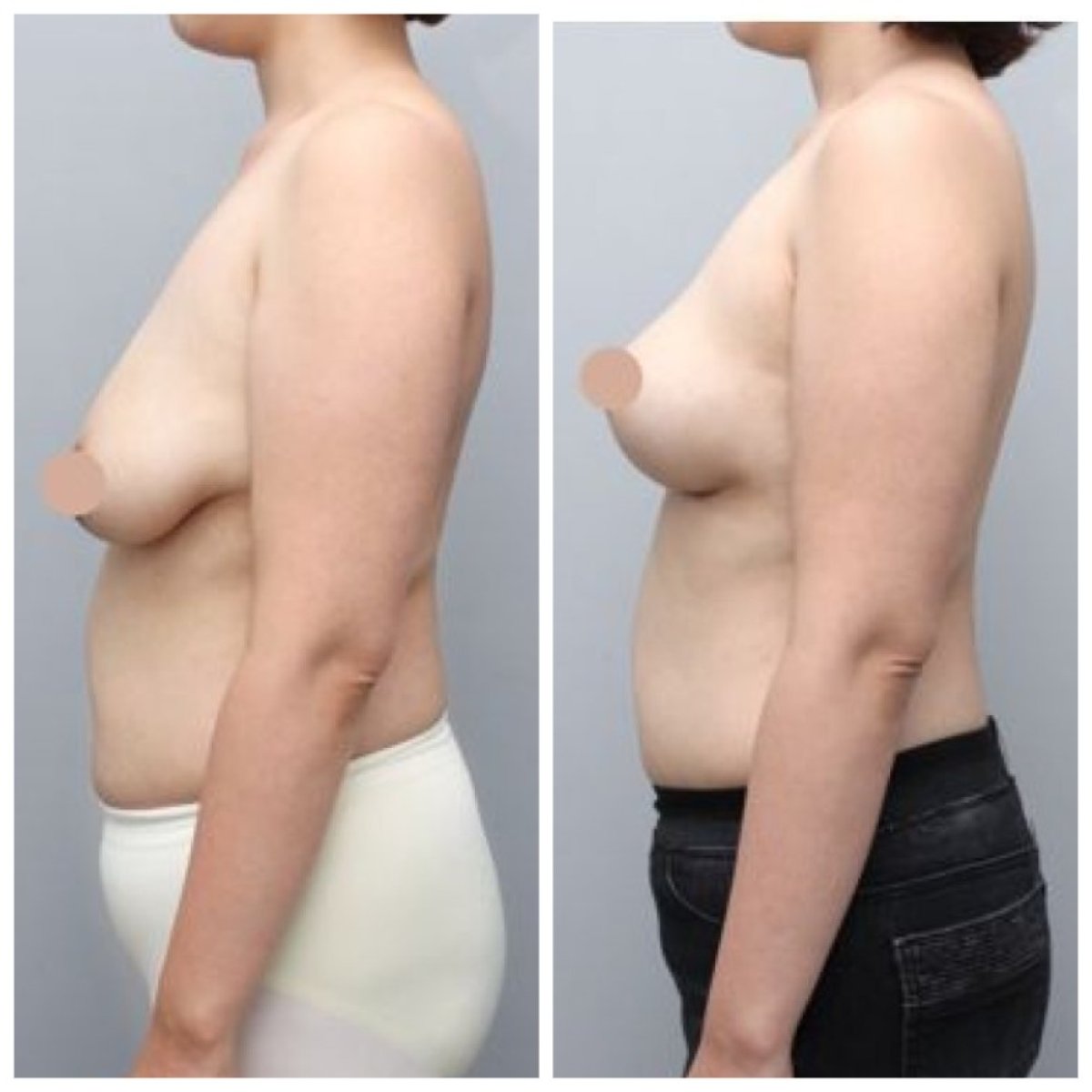 Результаты до и после подтяжки груди в AB Plastic Surgery – улучшенный контур груди