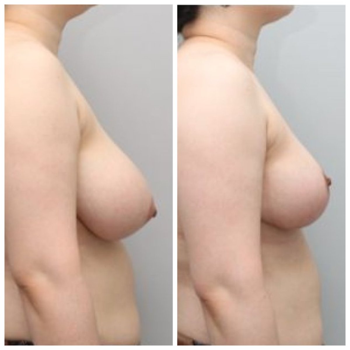 Before and after breast lift results at AB Plastic Surgery, improved breast contour and lift