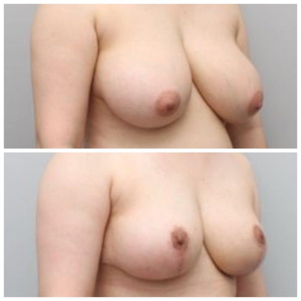نتائج شد الثدي قبل وبعد في AB Plastic Surgery – تحسين شكل ورفع الثدي