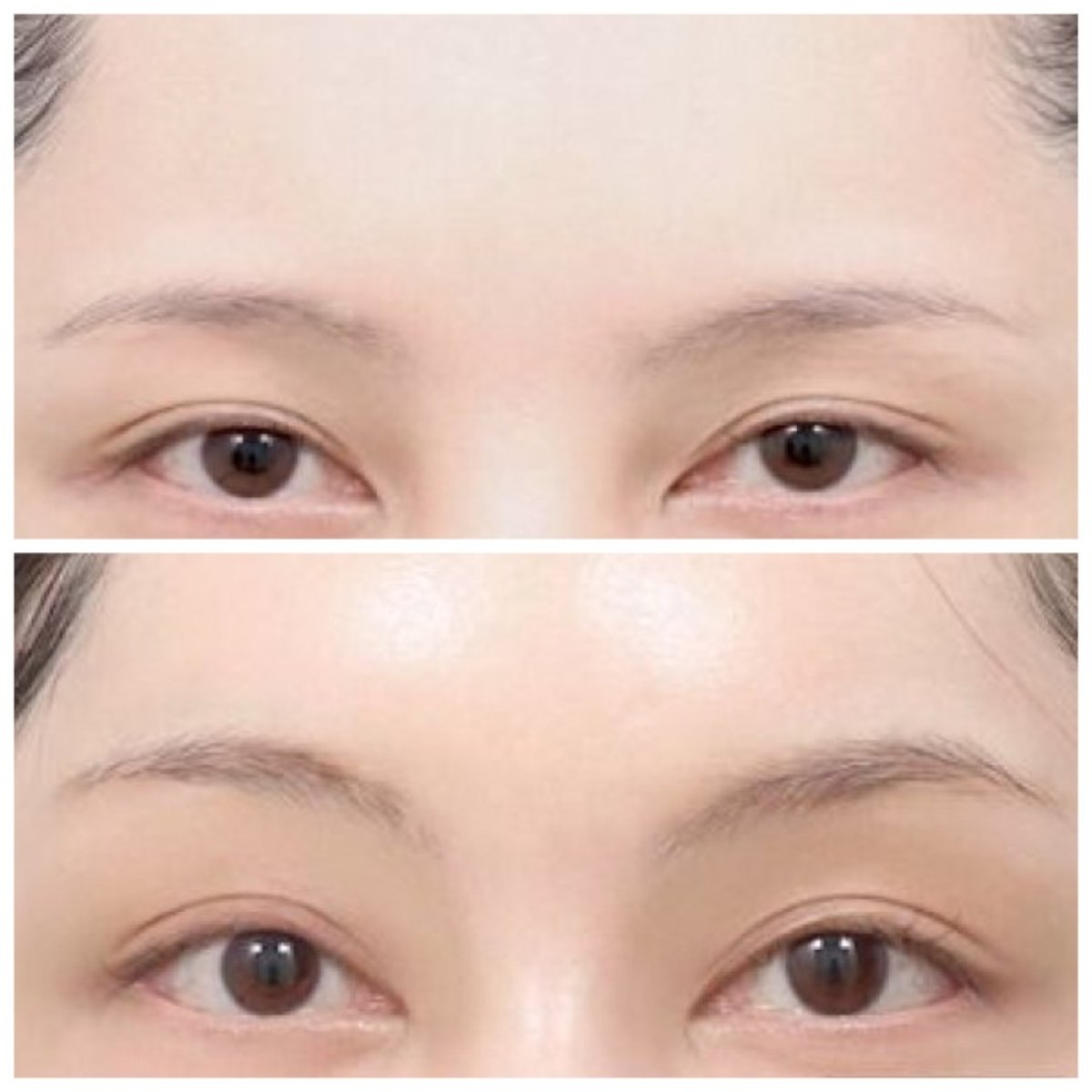 نتائج شد الجبهة قبل وبعد في AB Plastic Surgery، مظهر جبين أكثر نعومة