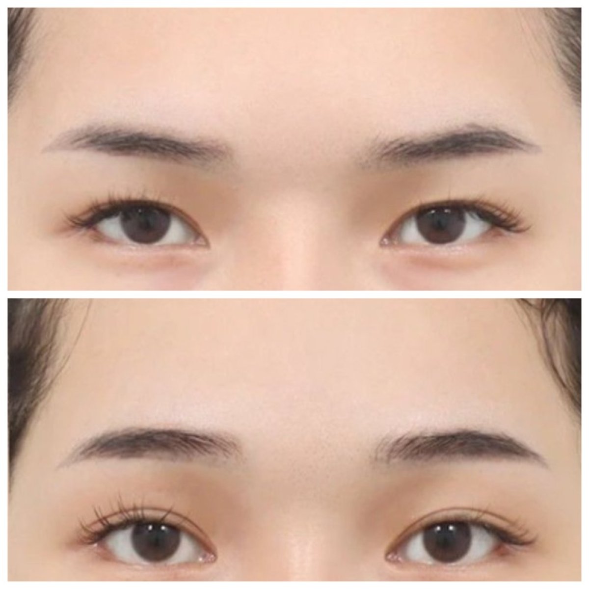 Resultados de lifting de frente antes y después en AB Plastic Surgery, elevación visible de cejas