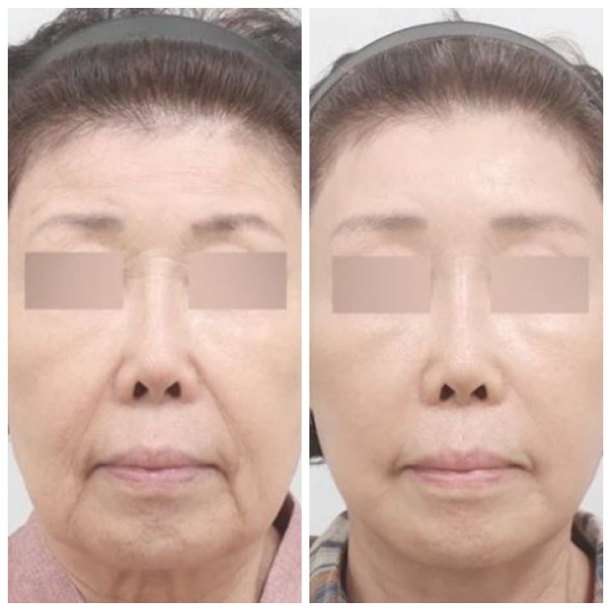 Результати підтяжки чола до і після в AB Plastic Surgery – гладке, молоде чоло
