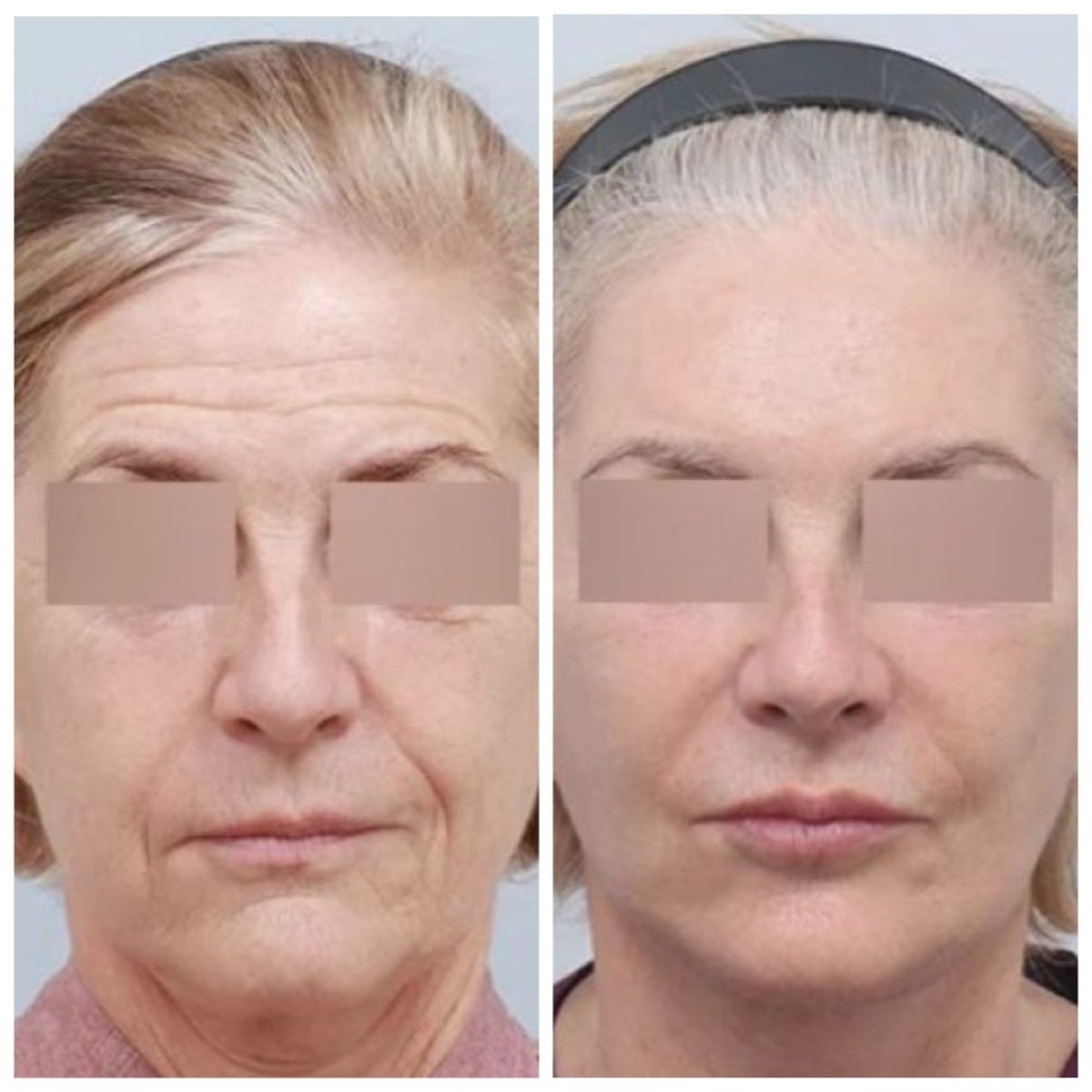 Resultados de lifting de frente antes y después en AB Plastic Surgery – frente más lisa y joven