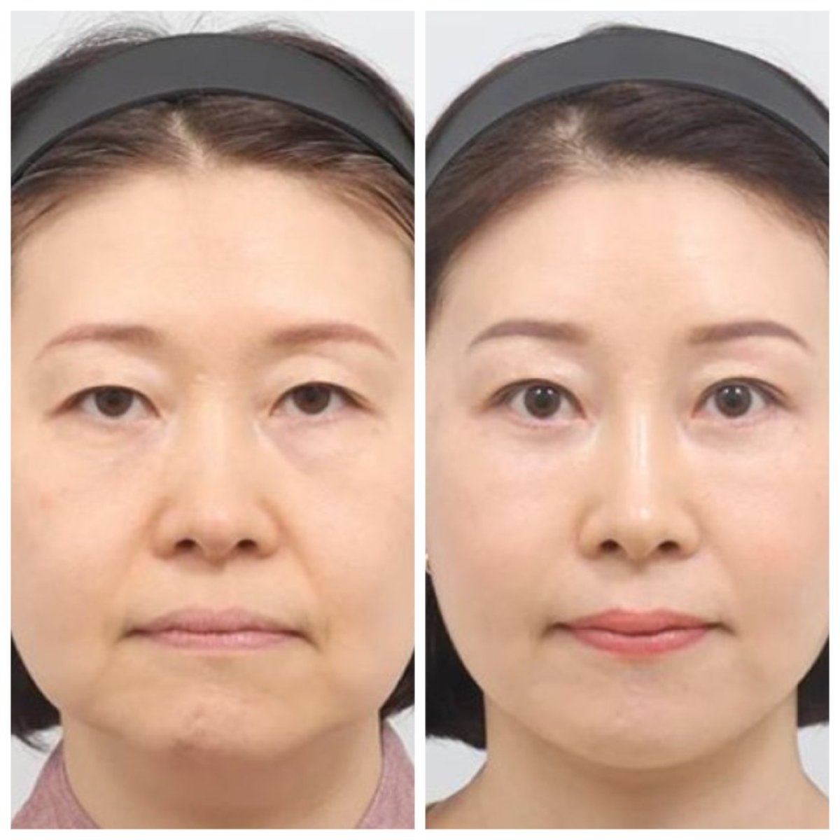 نتائج شد الجبهة قبل وبعد في AB Plastic Surgery – مظهر أكثر شباباً ونعومة