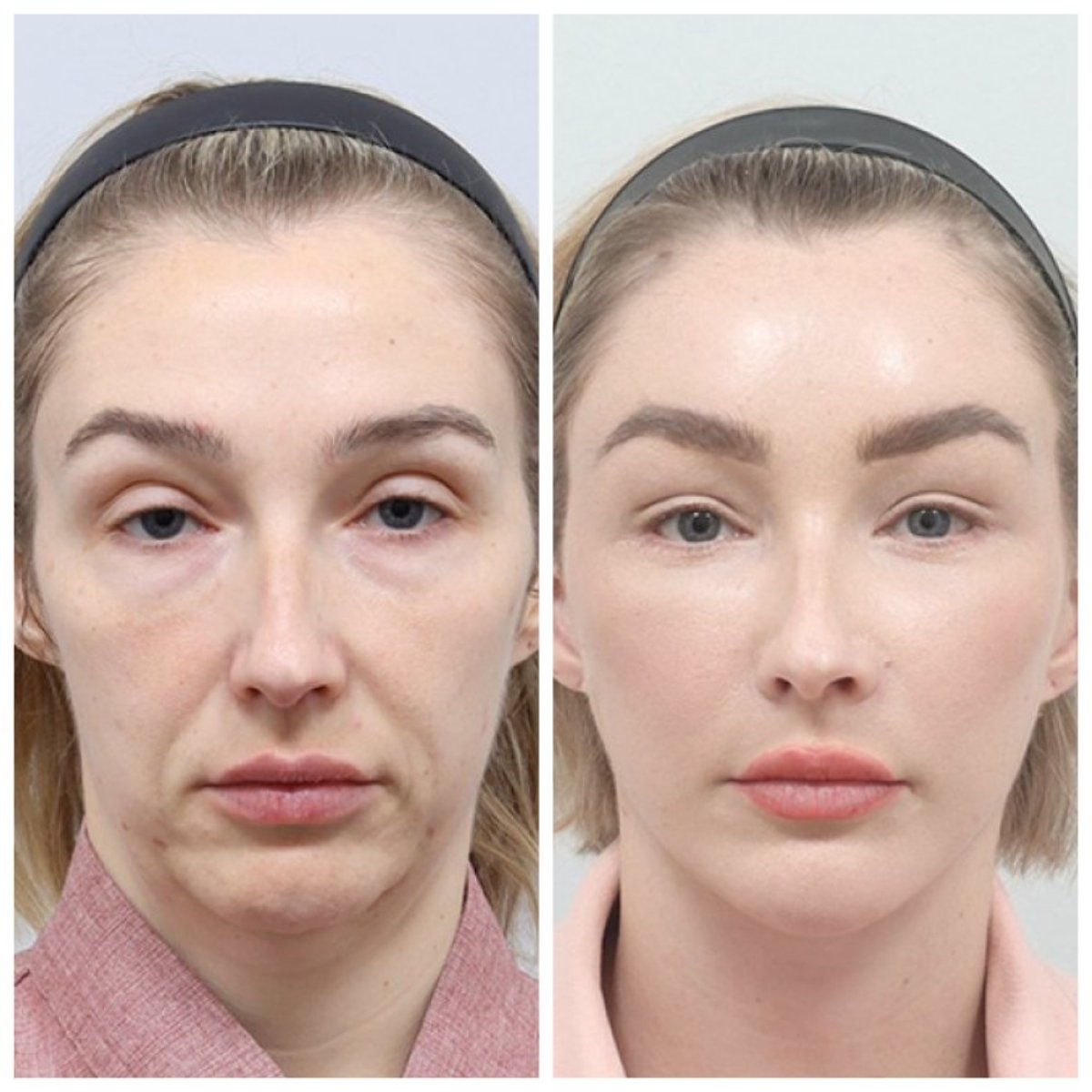Результати підтяжки чола до і після в AB Plastic Surgery – гладке, молоде обличчя