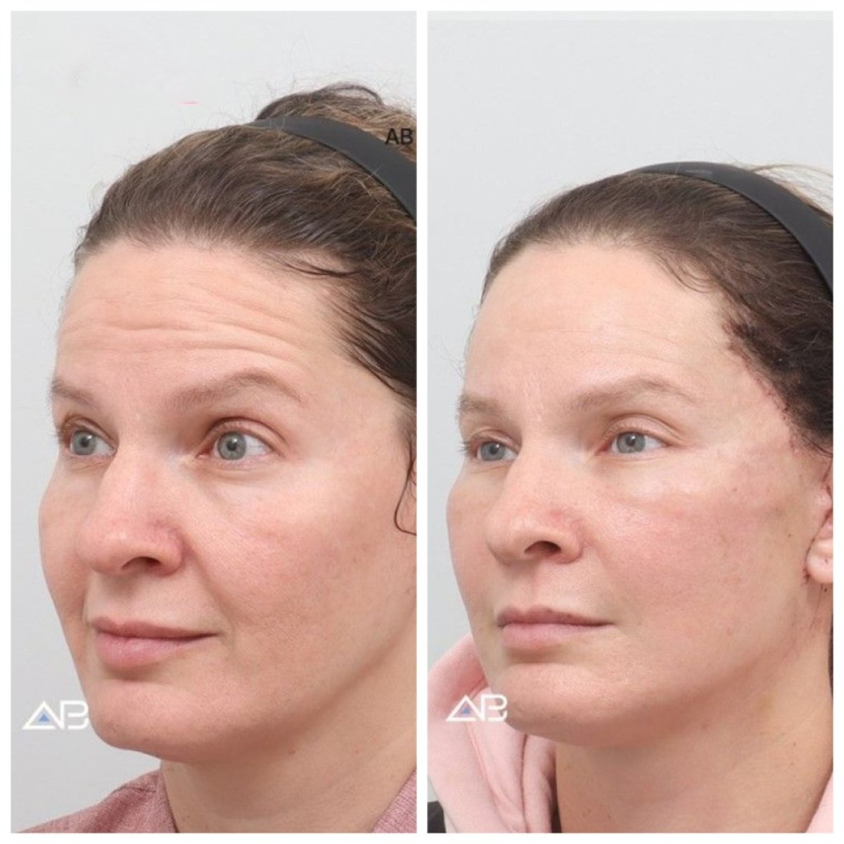 نتائج شد الوجه قبل وبعد في AB Plastic Surgery، تجديد ورفع واضح للوجه