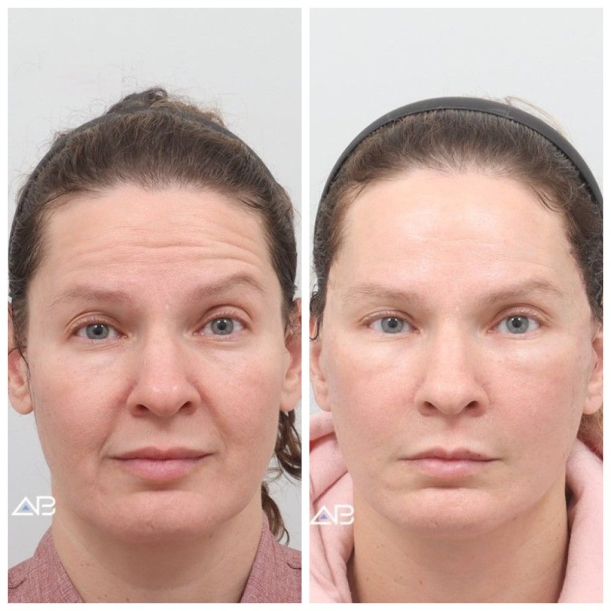 Результати до та після підтяжки обличчя в AB Plastic Surgery, помітне омолодження