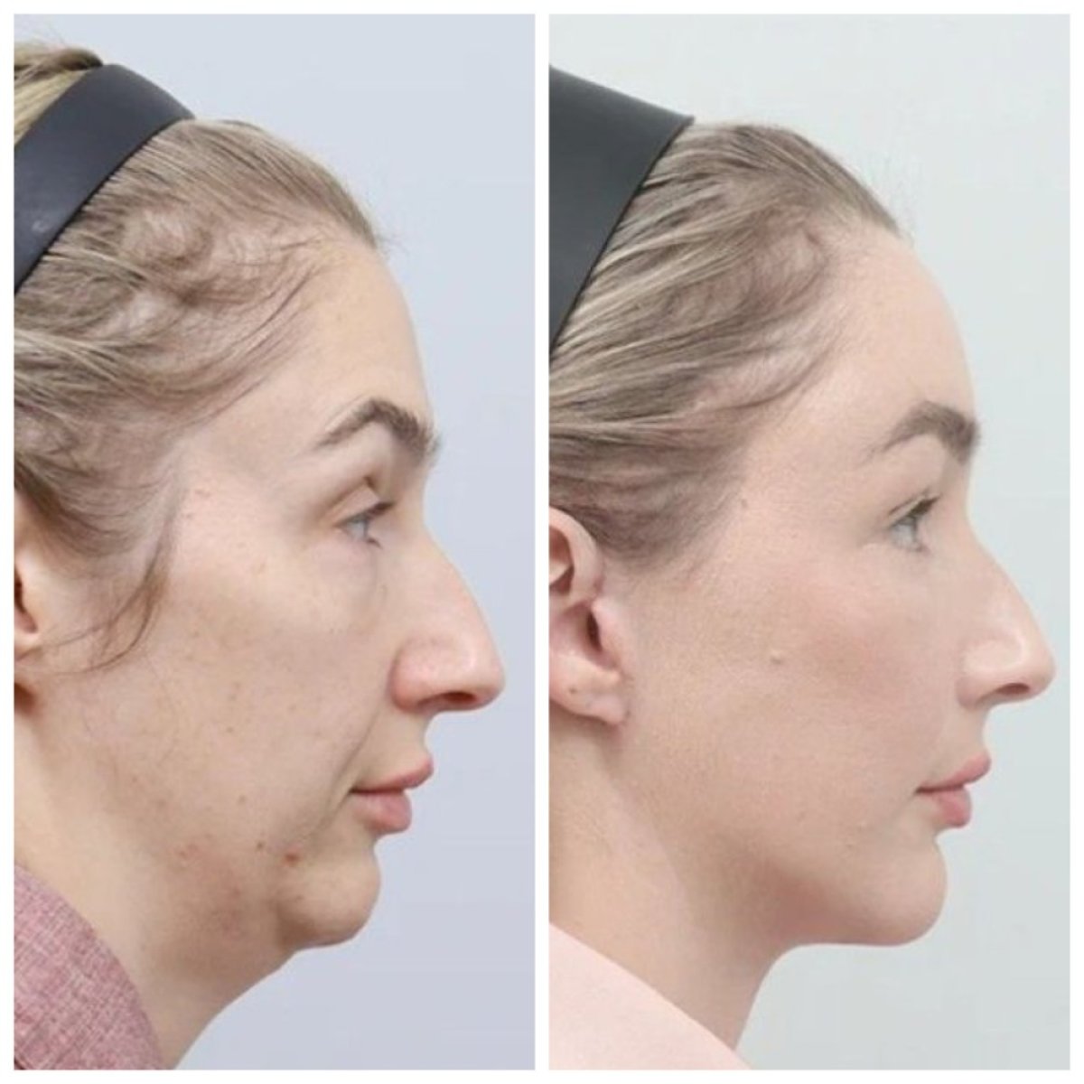 Before and after facelift results at AB Plastic Surgery, visible jawline and neck tightening