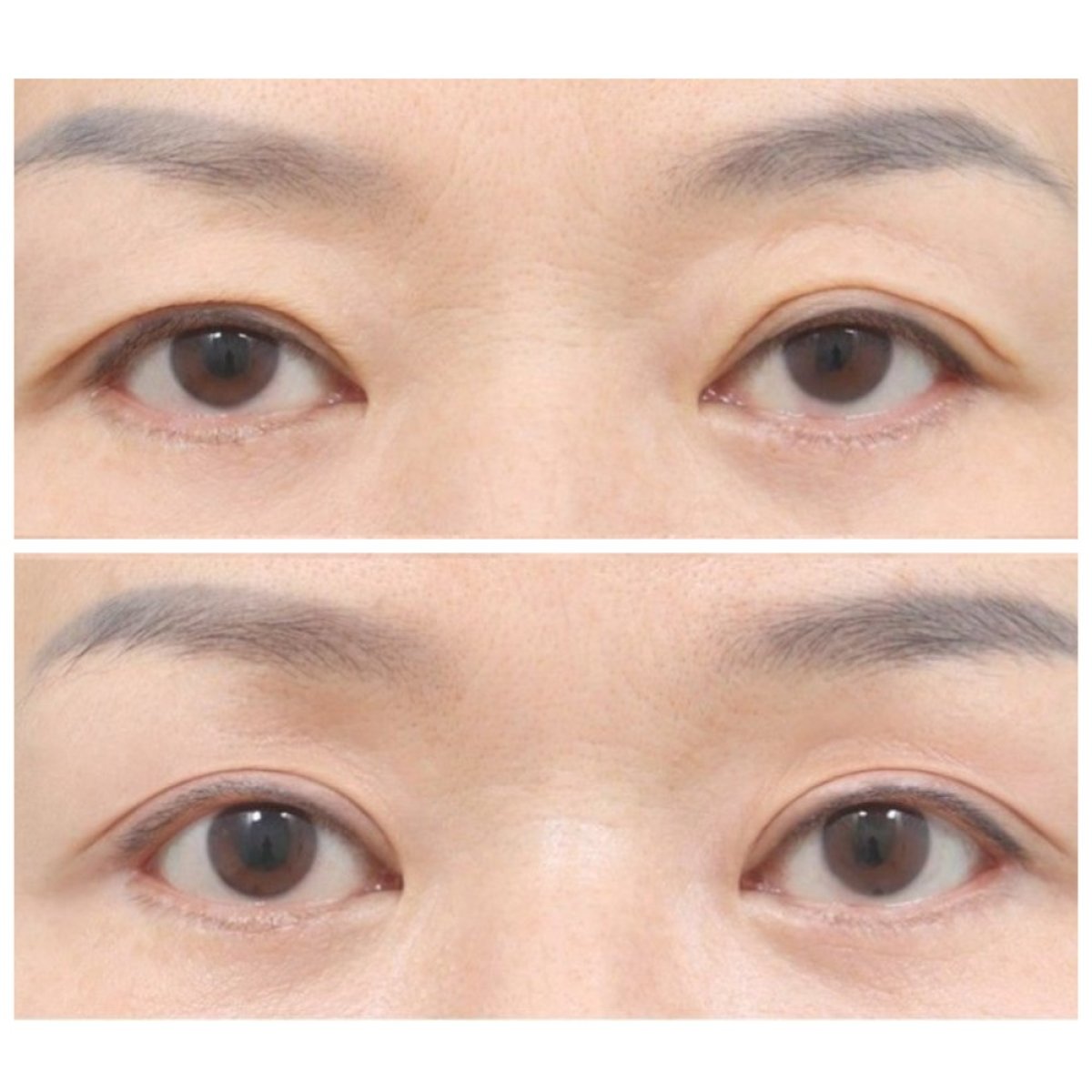 Resultados de blefaroplastia antes y después en AB Plastic Surgery, corrección de párpados