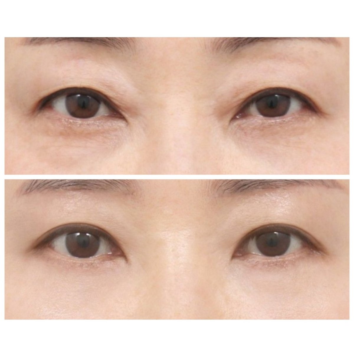 Résultats avant et après blépharoplastie chez AB Plastic Surgery, correction des paupières