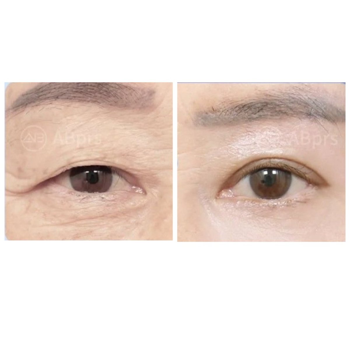 Resultados de blefaroplastia antes y después en AB Plastic Surgery, corrección de párpados