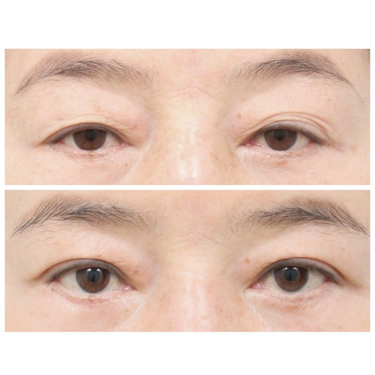 Before and after blepharoplasty at AB Plastic Surgery, eyelid correction visible result