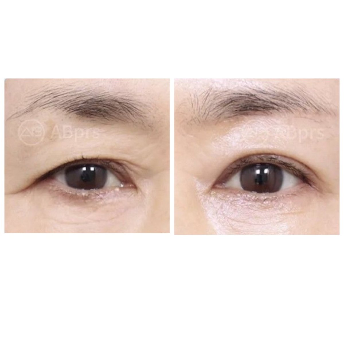 Résultats avant/après blépharoplastie chez AB Plastic Surgery, correction des paupières