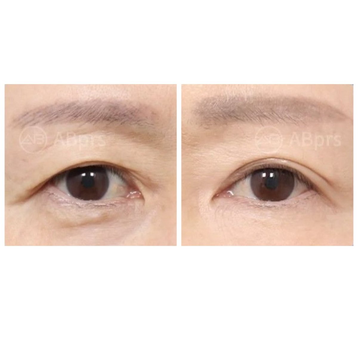 Before and after blepharoplasty results at AB Plastic Surgery, eyelid correction improvement