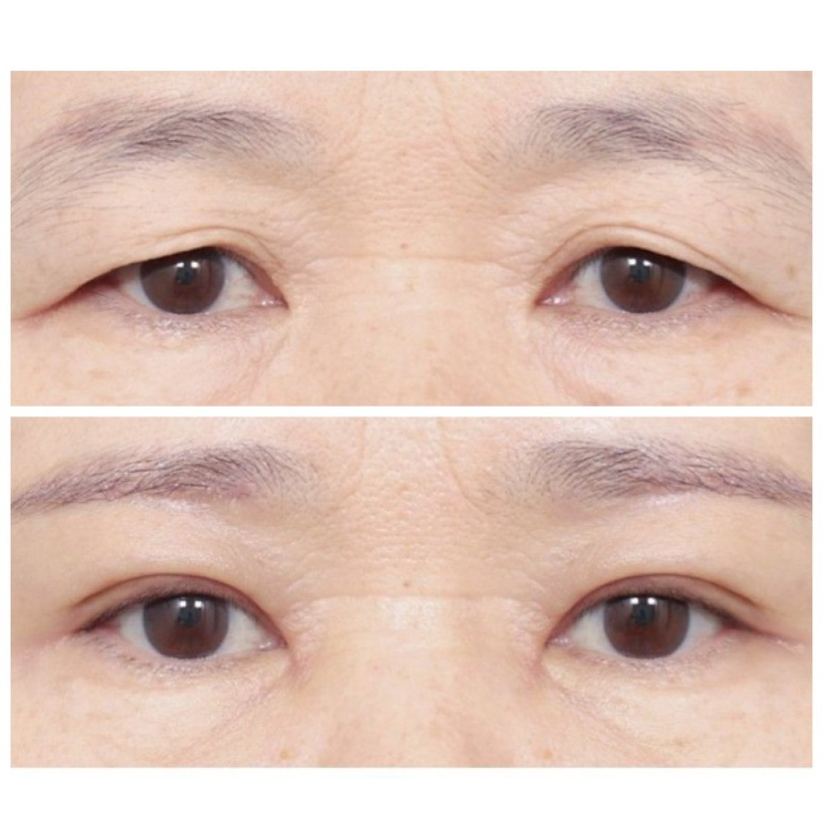 Resultados de blefaroplastia antes y después en AB Plastic Surgery, corrección de párpados