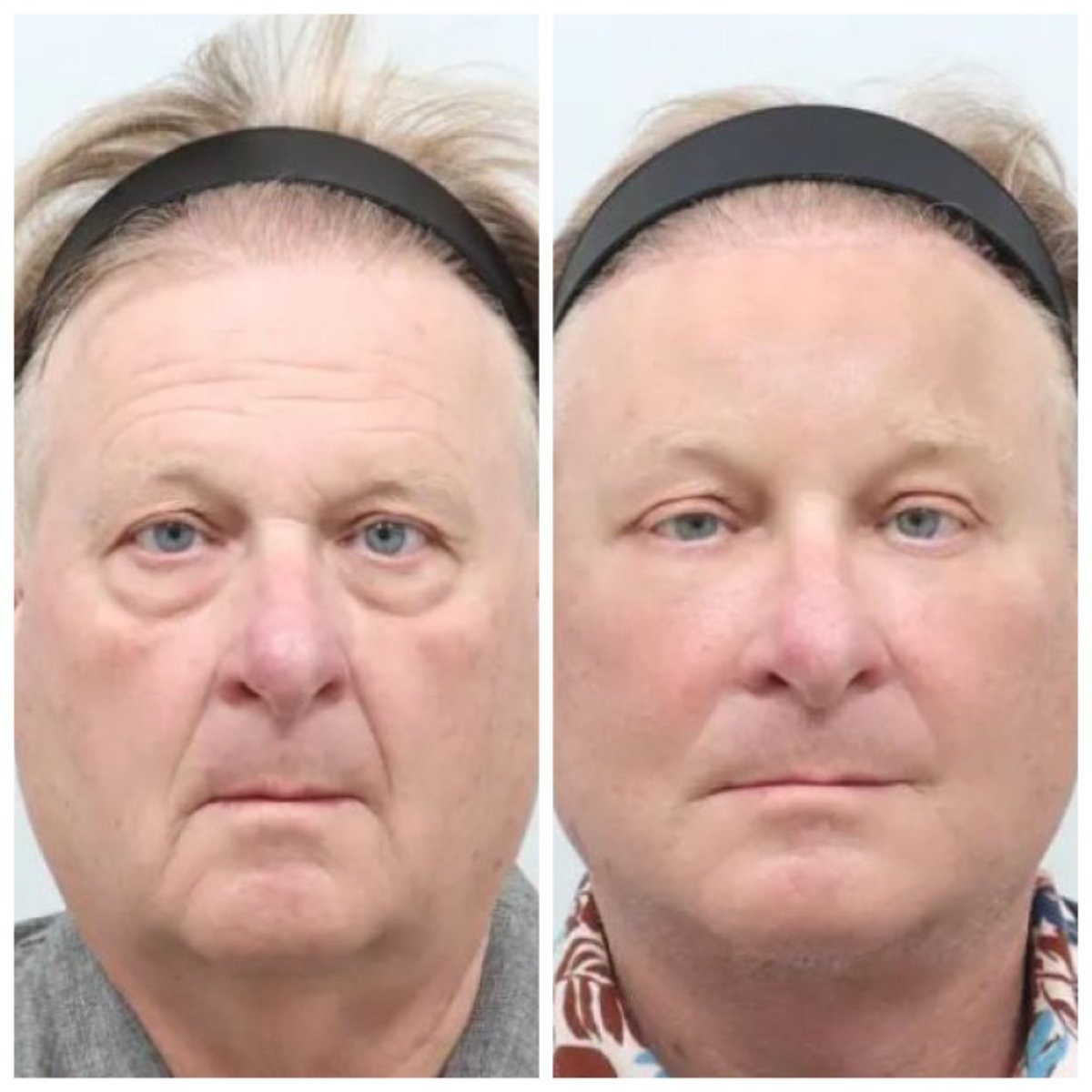 Efekty przed i po deep plane facelift w AB Plastic Surgery, widoczne odmłodzenie twarzy