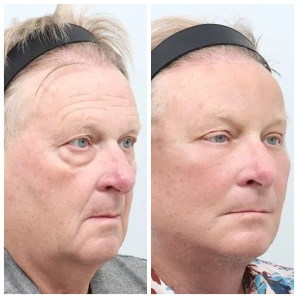 Результати до і після deep plane SMAS підтяжки в AB Plastic Surgery, омолодження обличчя