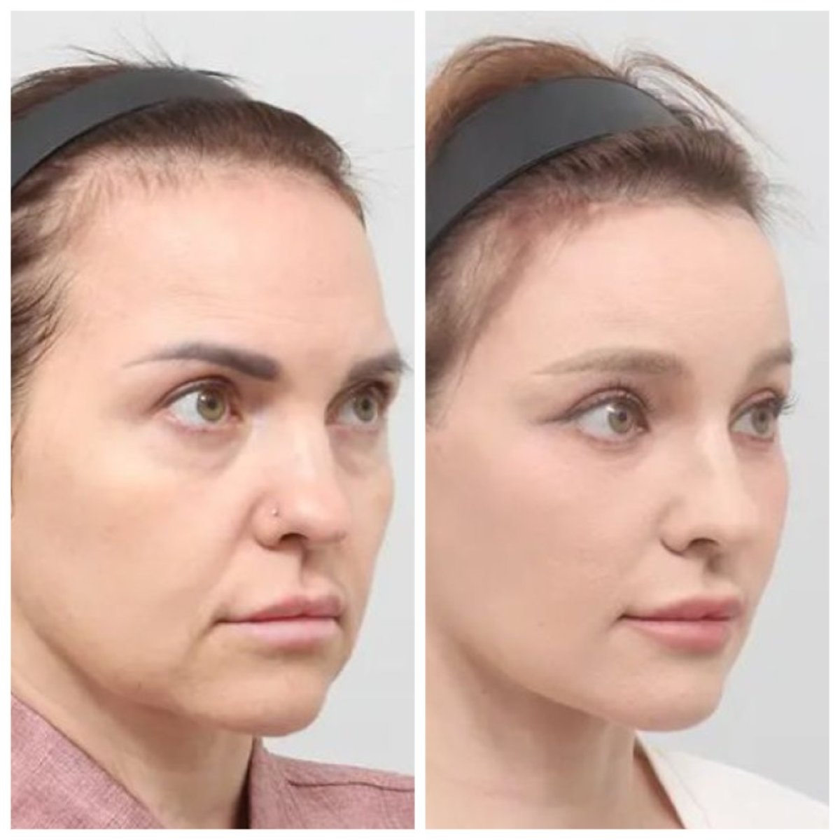 Efekty przed i po deep plane facelift w AB Plastic Surgery, widoczne odmłodzenie twarzy