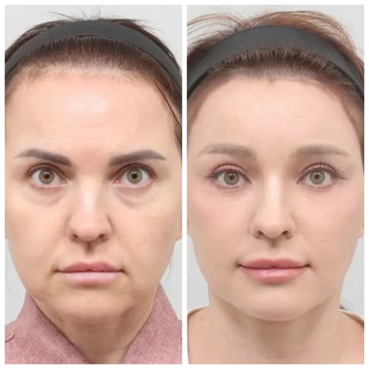 نتائج شد الوجه العميق قبل وبعد في AB Plastic Surgery – تجديد شباب الوجه واضح