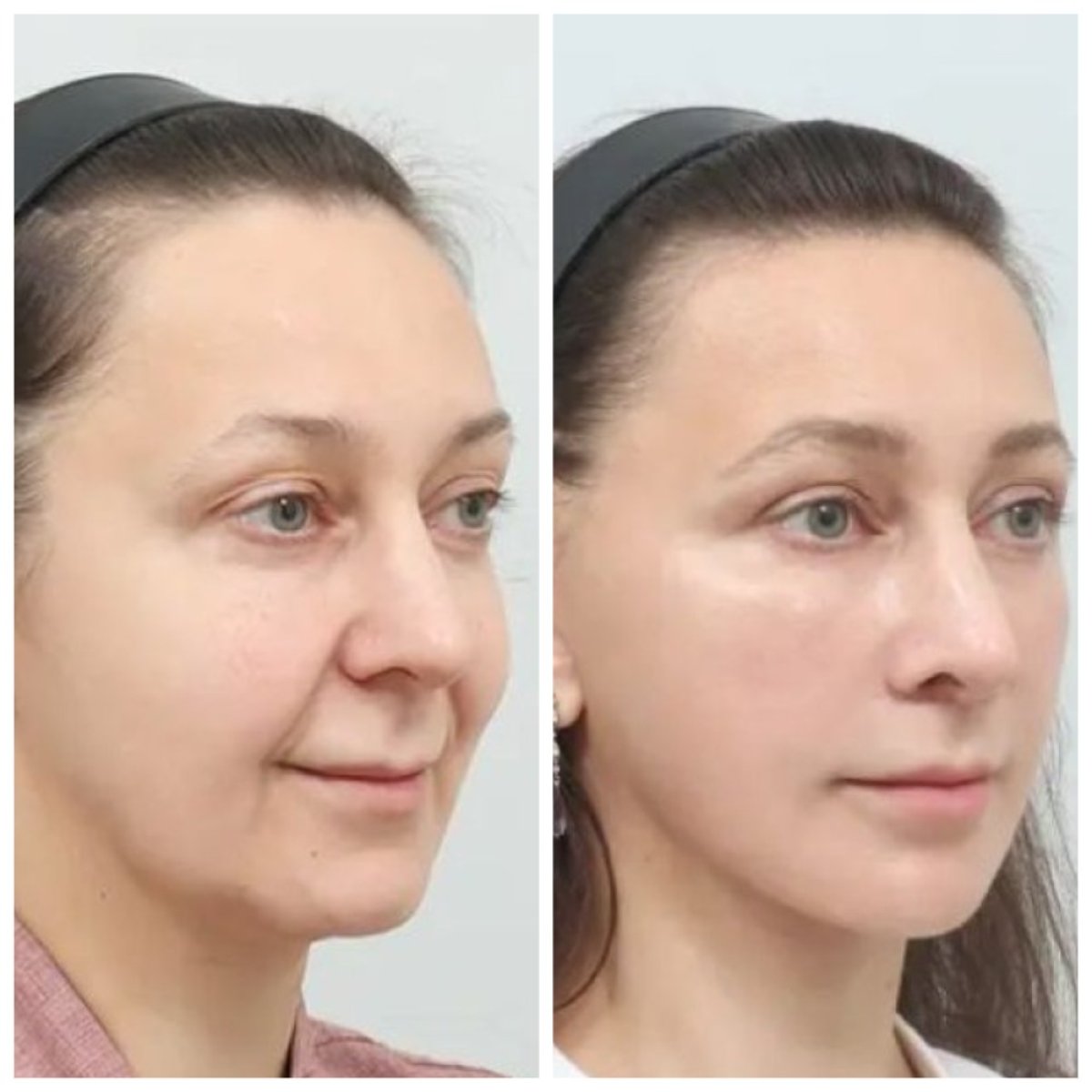 Результат до та після deep plane SMAS-ліфтингу в AB Plastic Surgery – омолодження обличчя