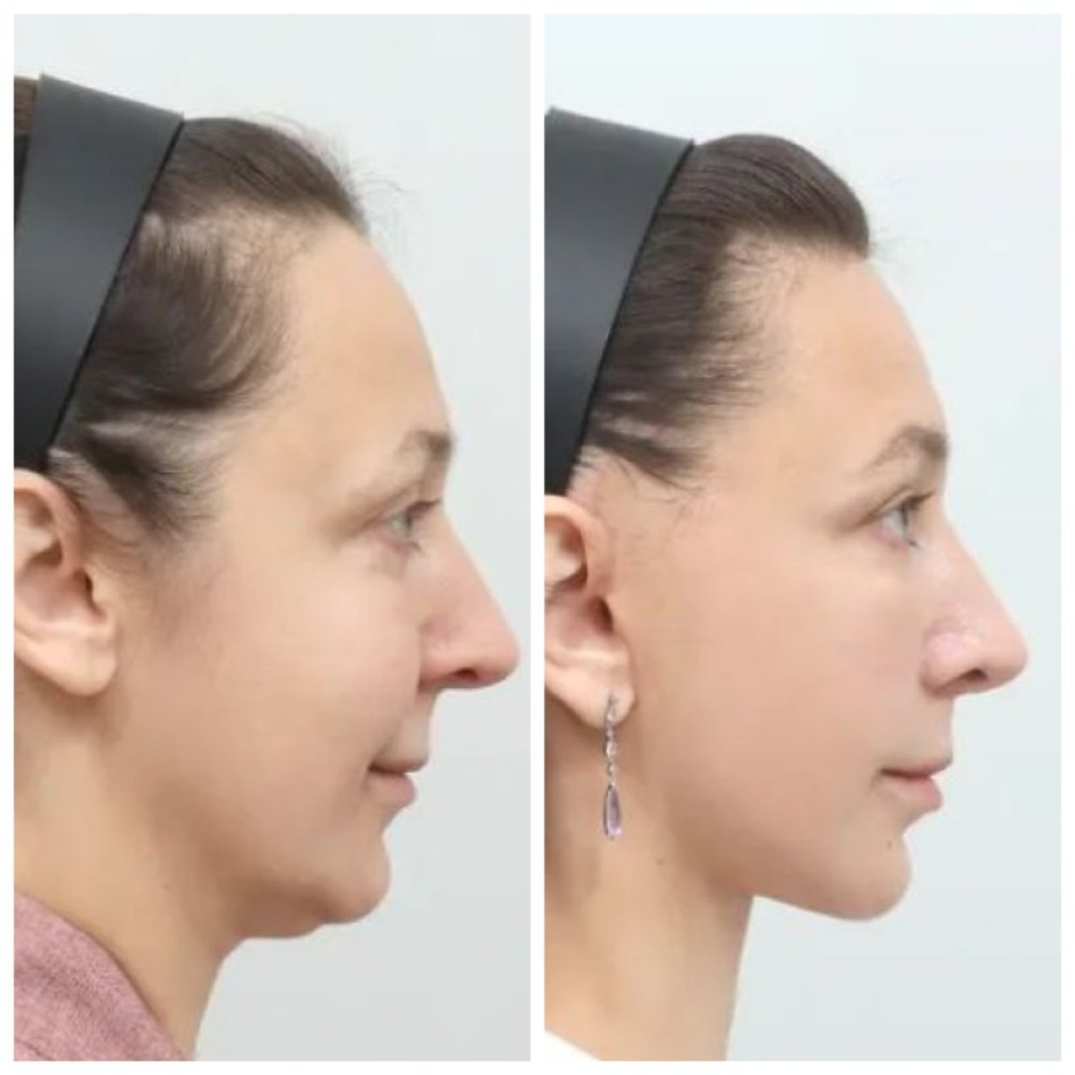 Результат до і після deep plane SMAS підтяжки в AB Plastic Surgery – чіткіший овал обличчя