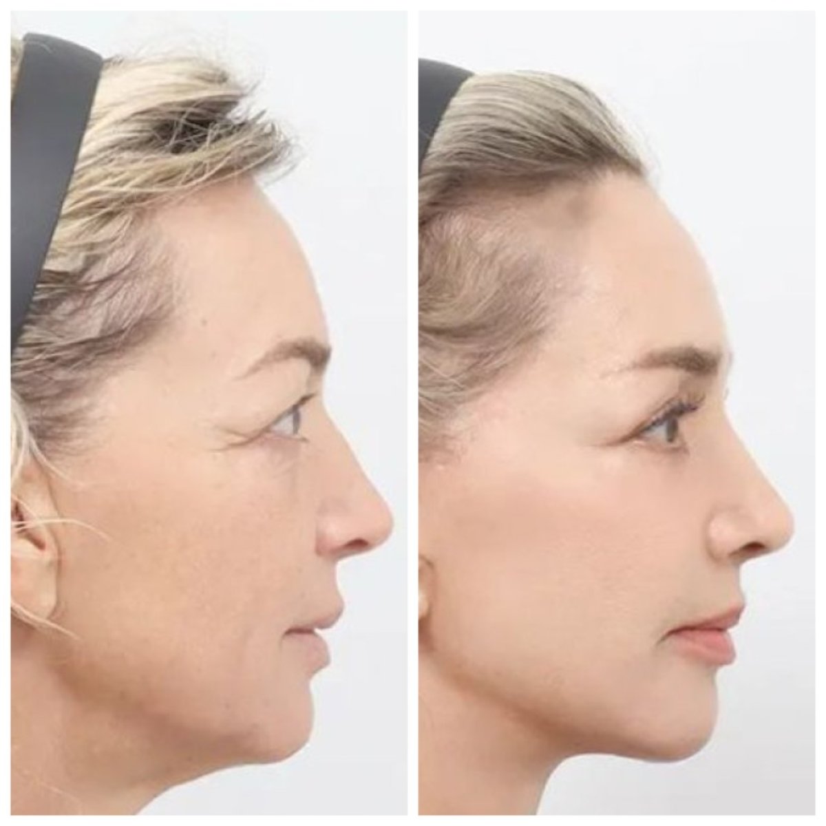 نتائج قبل وبعد شد الوجه العميق في AB Plastic Surgery – تجديد شباب الوجه واضح