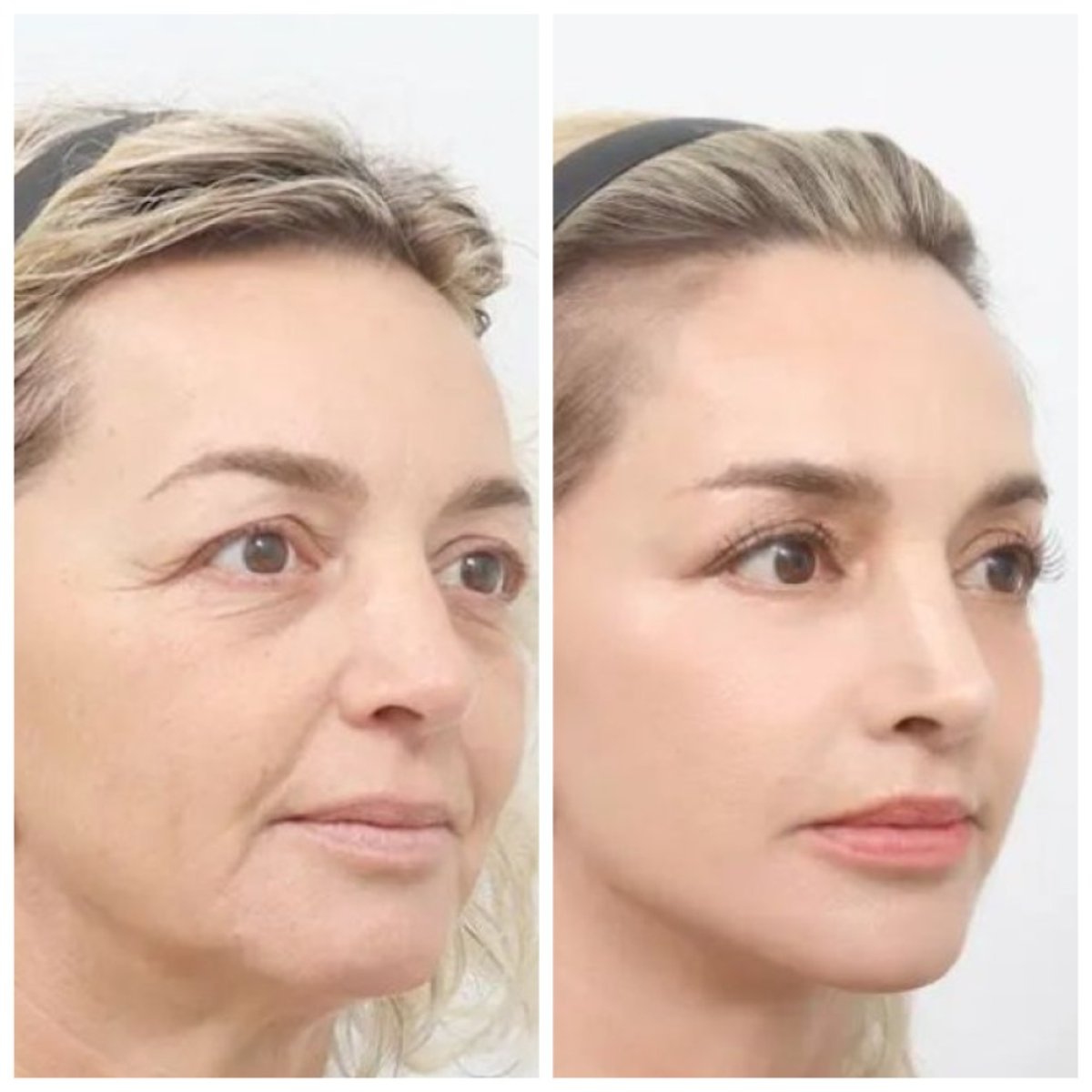 نتائج شد الوجه العميق قبل وبعد في AB Plastic Surgery، تجديد واضح للوجه