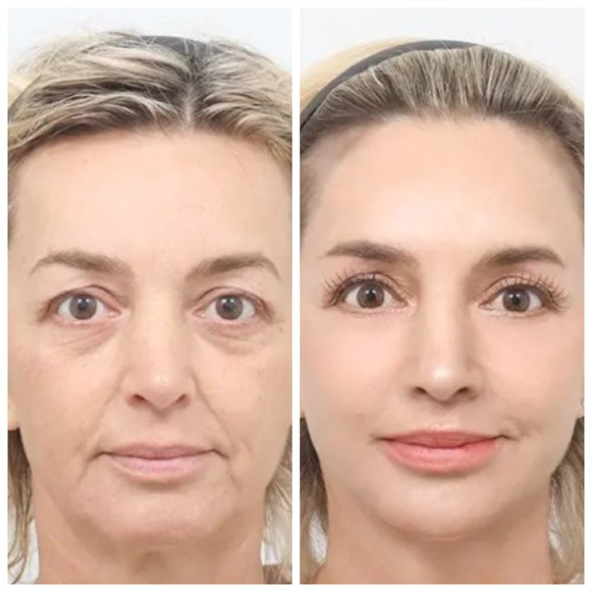 نتائج شد الوجه العميق قبل وبعد في AB Plastic Surgery – تجديد شباب الوجه