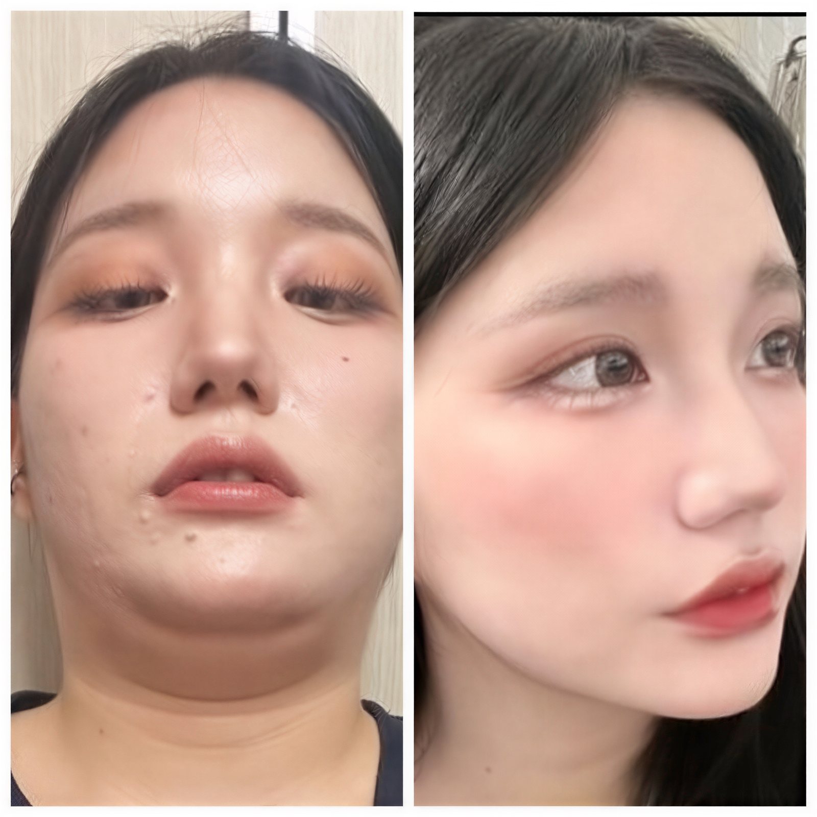 نتيجة شفط دهون الذقن قبل وبعد في AB Plastic Surgery – تحسين تحديد الفك