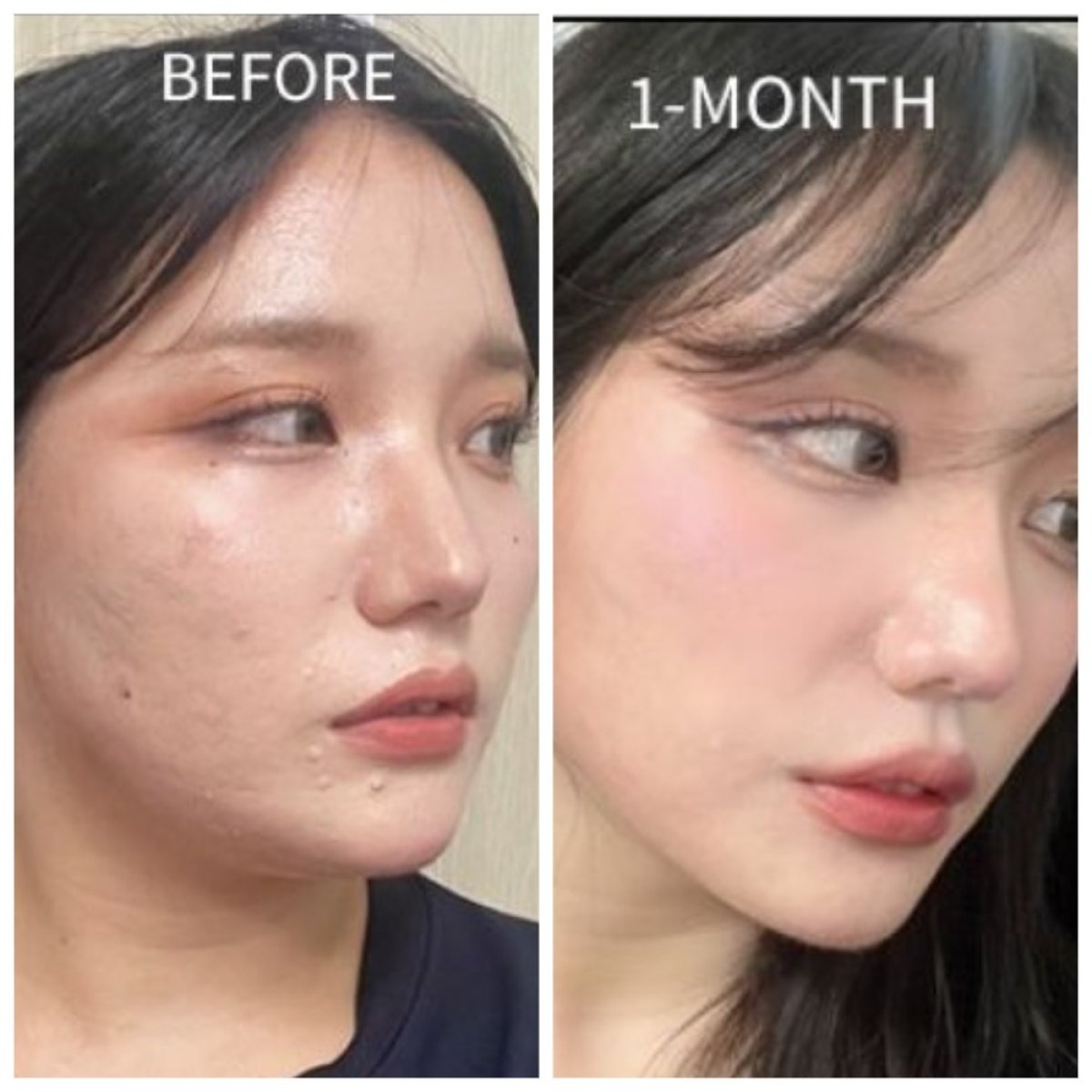 Résultats de liposuccion du menton chez AB Plastic Surgery – contour de mâchoire affiné