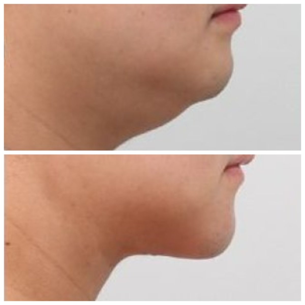 نتيجة شفط دهون الذقن قبل وبعد في AB Plastic Surgery – تحسين تحديد الفك