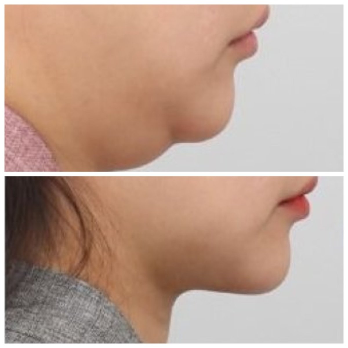 Результати ліпосакції підборіддя до і після в AB Plastic Surgery – покращений контур